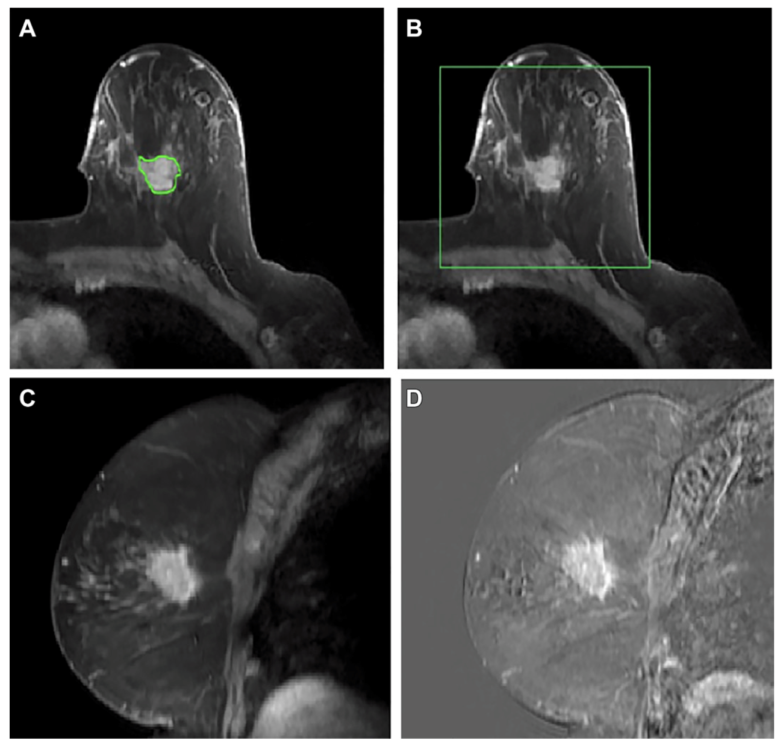 Four boxes showing how the model processes breast cancer MRIs .