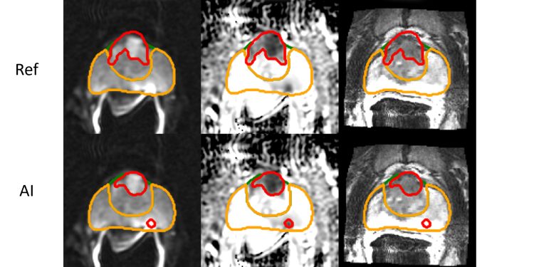 “Yapay Zeka Araştırmaları, Prostat Kanseri Tahminlerinde Hızlı ve Doğru Sonuçlar Sunuyor”