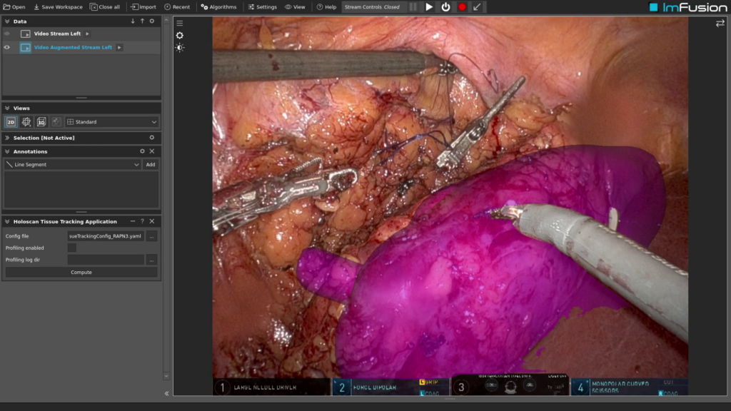 Screenshot of the Holoscan tissue tracking application. Within the ImFusion application, using the Holoscan tissue tracking application. the surface mesh is colored magenta, does not occlude any surgical instruments, and fits to the underlying target tissue.