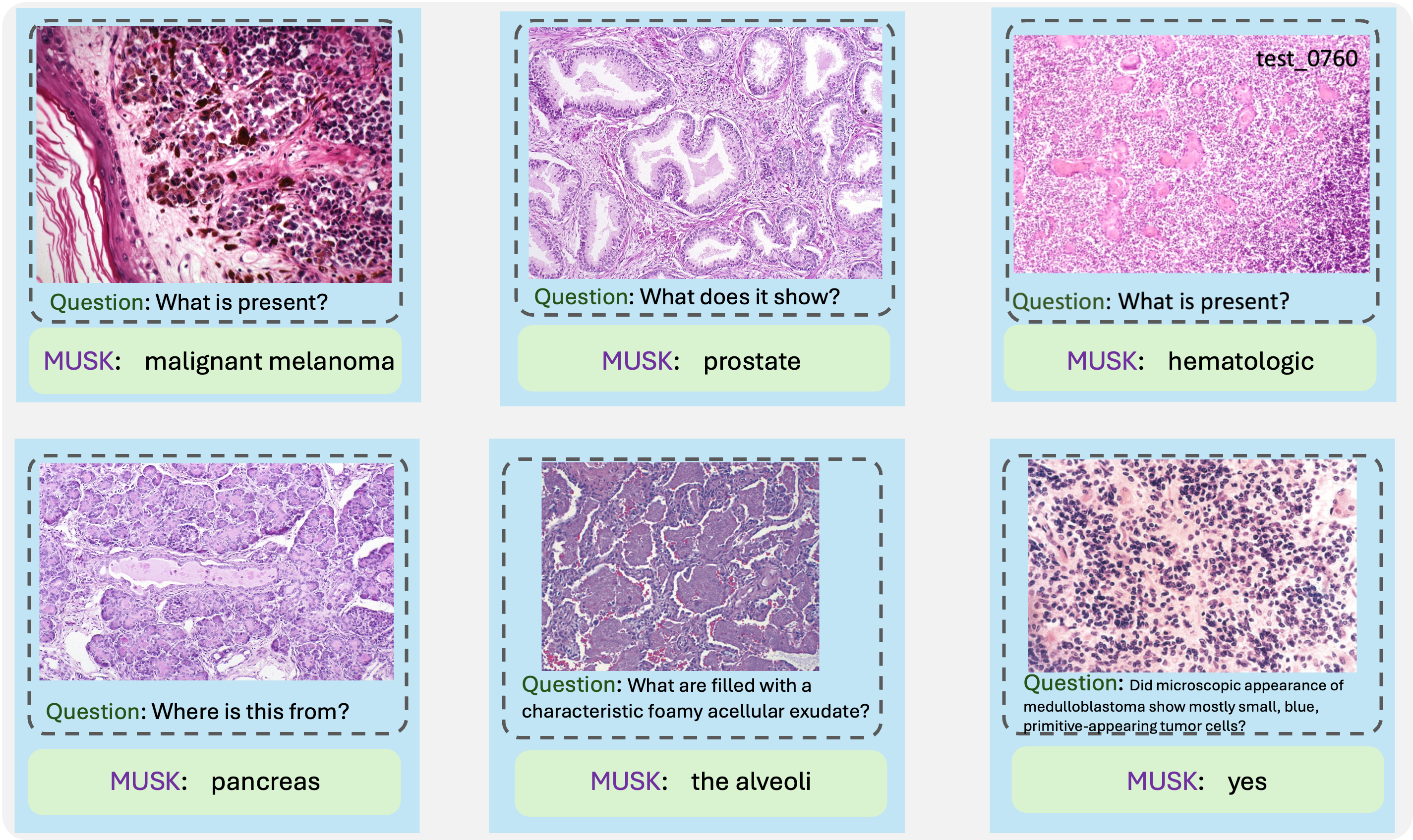 6 slides showing various questions that MUSK answers about a cancer slide.