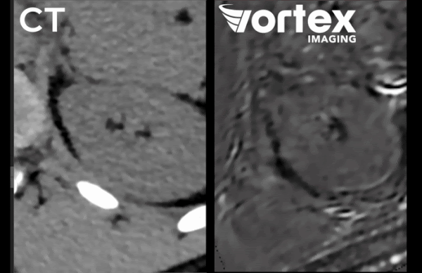vortex-gif-2 A GIF of a side-by-side comparison of Vortex vs. CT imaging of human kidney slices presenting detailed anatomical cross-sections.