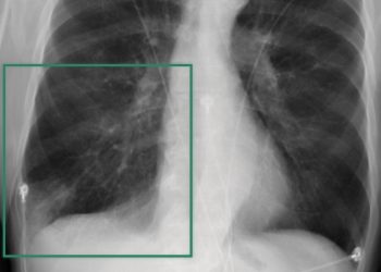 NVIDIA Clara Reason ile Radyoloji Araştırmalarında Açıklanabilir Yapay Zeka Geliştirme